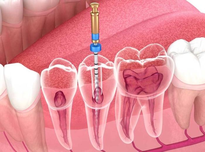 Resolve Tooth Pain and Restore Your Oral Health with Root Canal Therapy
