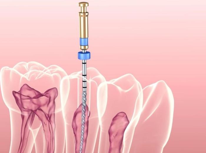 How Long Do Root Canals Take? Five Questions to Ask Your Endodontist