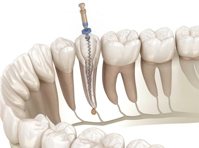Biological Endodontics: Understanding the Natural Approach to Root Canal Therapy