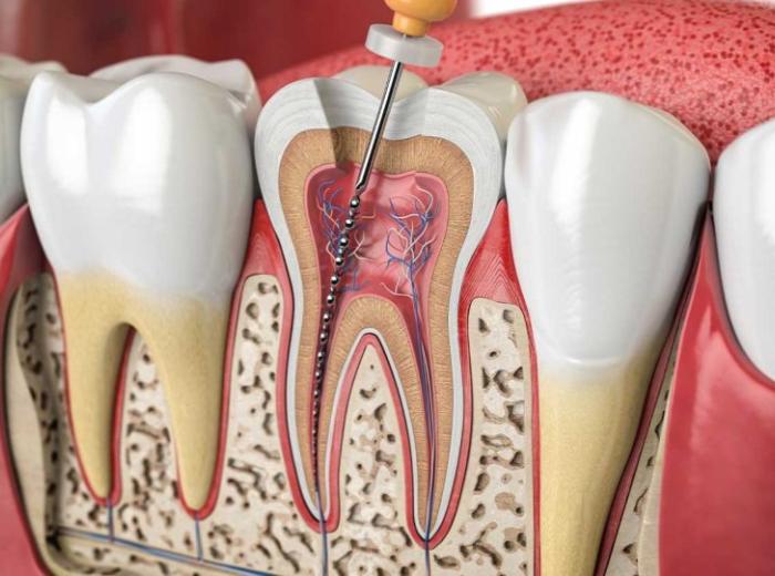 Can root canals affect your health? How safe are root canals?