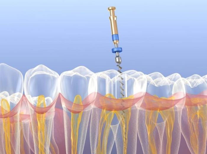 Is Root Canal Treatment Really Worth It? Insights from Endodontics Associates of Georgia