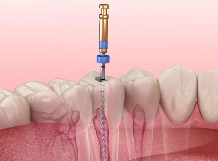 Is It Okay to Avoid a Root Canal? Six Negative Consequences You Can Expect
