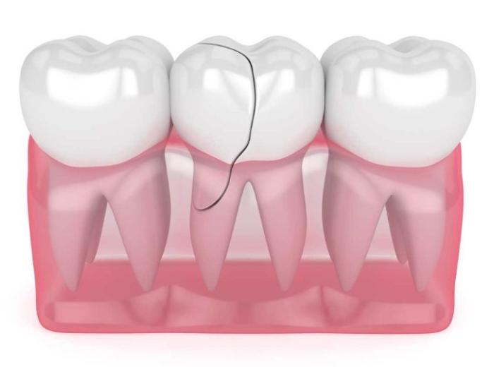 Save Your Tooth and Oral Health with Cracked Tooth Treatment