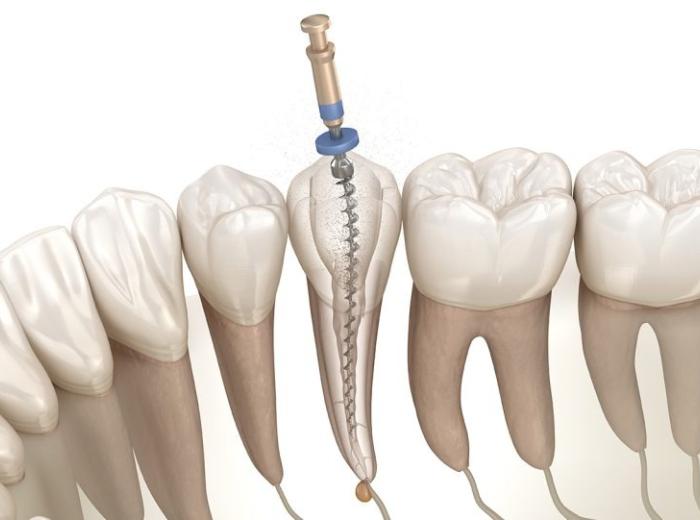 Experience Lasting Oral Health with Advanced Endodontic Care