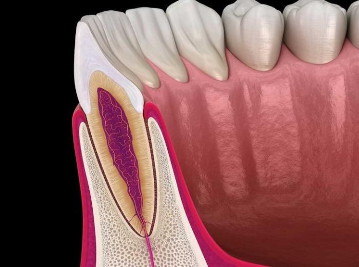Understanding Apicoectomy: Dental Procedure Explained