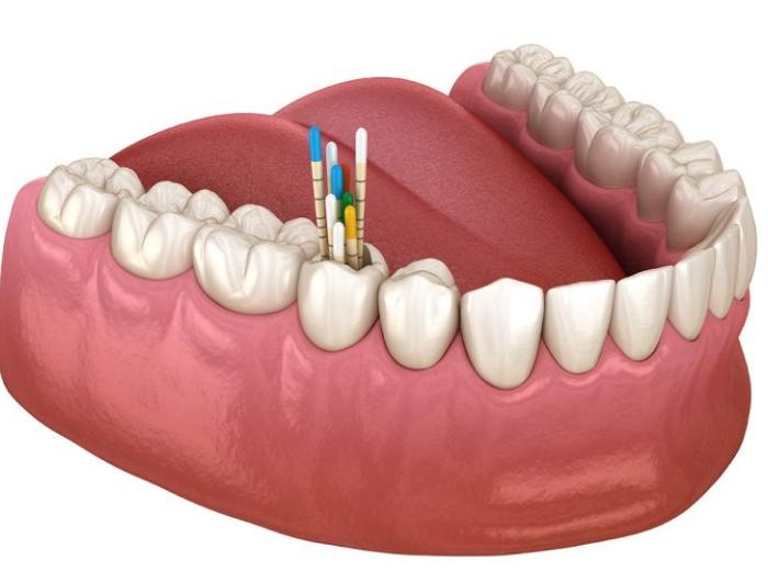 5 Common Myths About Root Canals – Debunked by Endodontics Associates of Georgia