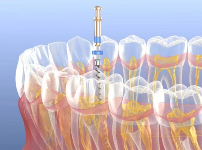 Root canal therapy, a safe and effective restorative dental treatment
