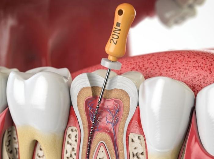 What happens during the root canal procedure with an endodontist in the Roswell, Georgia area?