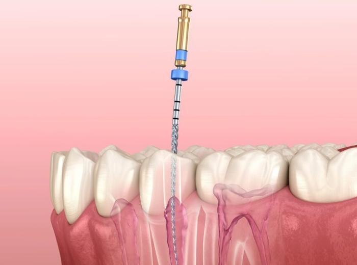 Root Canal Specialist in Cartersville, Georgia