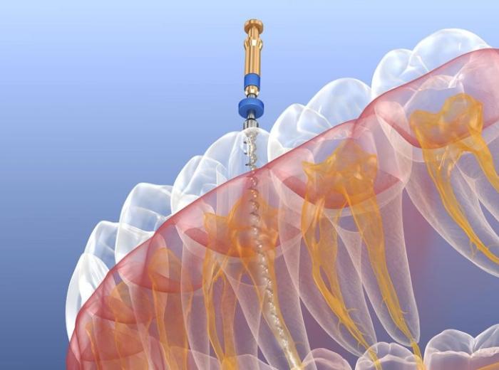 Where can I find a good endodontist close to me in Cartersville, Georgia?