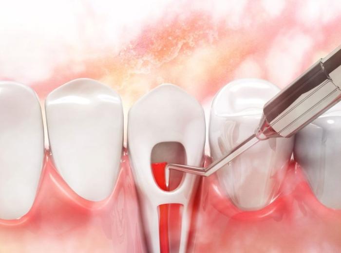 Visit our Kennesaw, Georgia, office to learn more about endodontic services with a root canal specialist