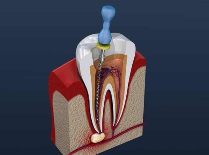 Endodontic Treatment Near Me in Atlanta, Georgia