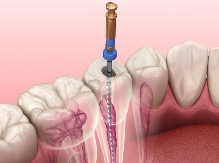 Six Unparalleled Endodontic Services You Can Enjoy from a Root Canal Dentist Near You