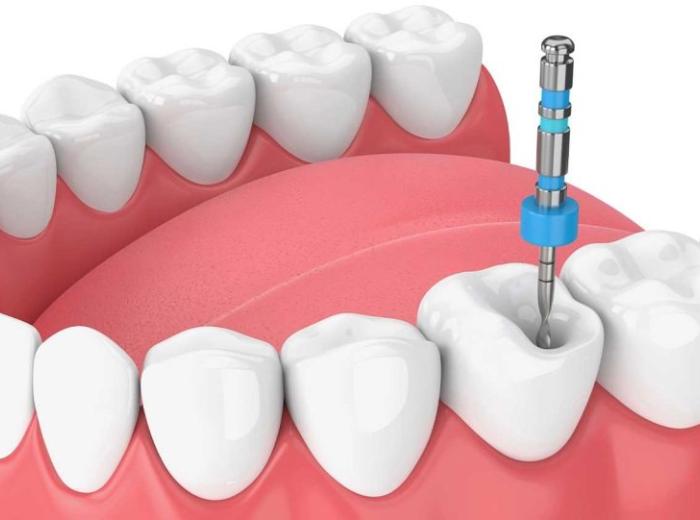 Busting Common Myths About Root Canal Treatment