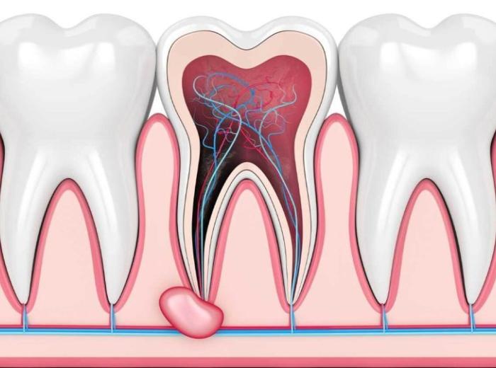 Are Root Canals Safe? What You Need to Know