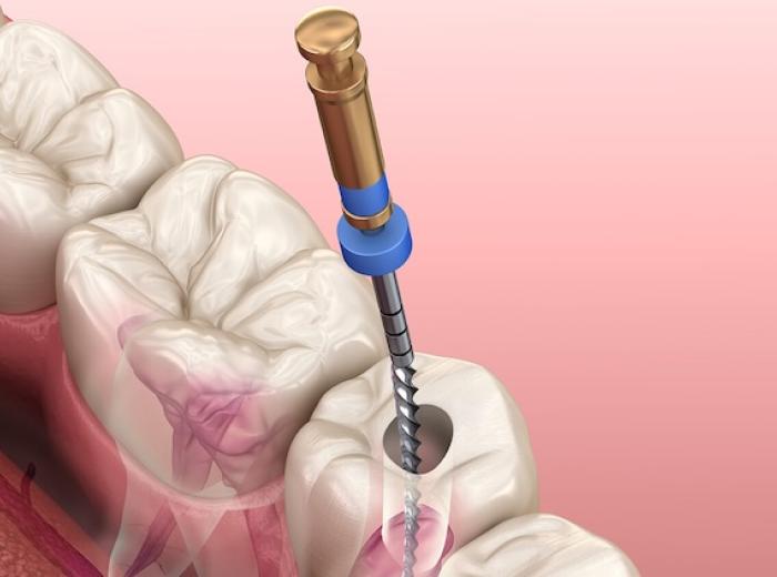 We Promote Long-term Oral Health with our Comprehensive Root Canal Services