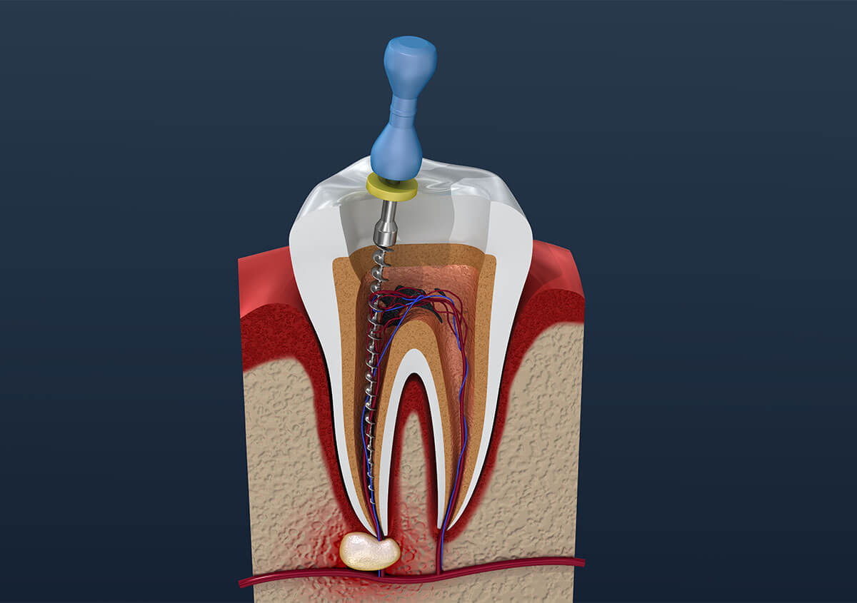 Myths About Root Canals in Atlanta GA Area